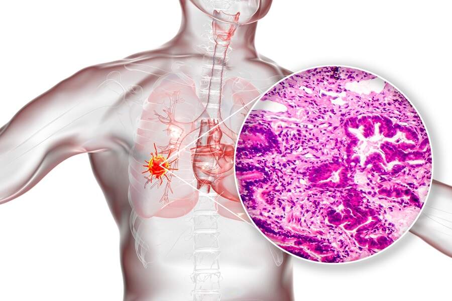 Image: AI could predict the spread of lung cancer to the brain (Photo courtesy of Adobe Stock)